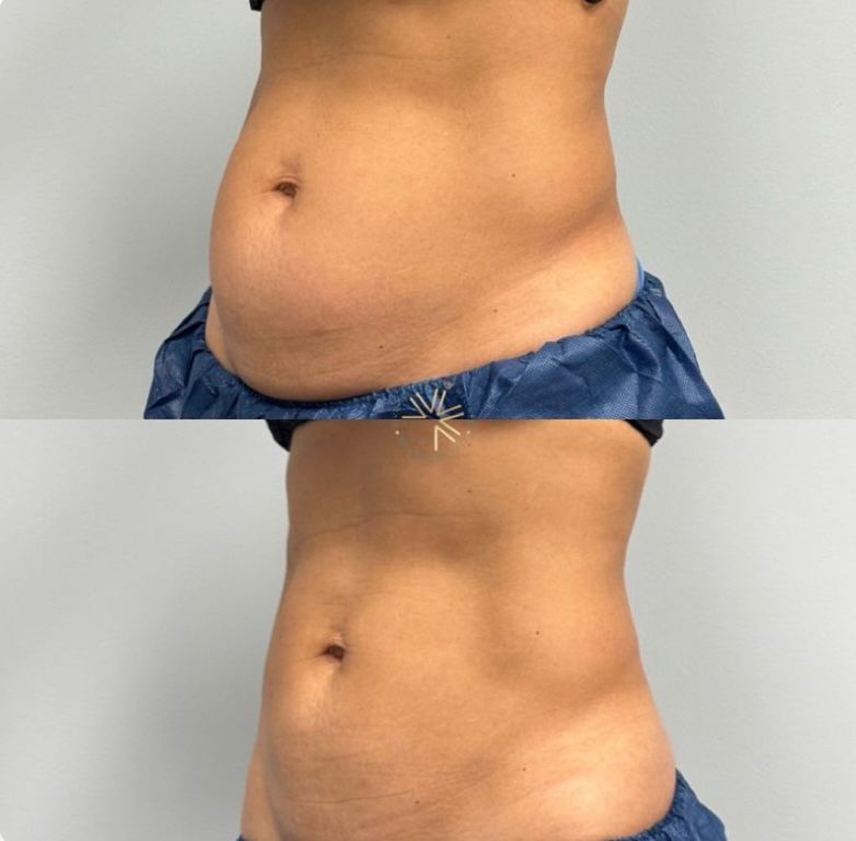 Bölgesel zayıflama görsel 2