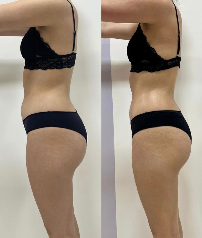 Bölgesel zayıflama görsel 1