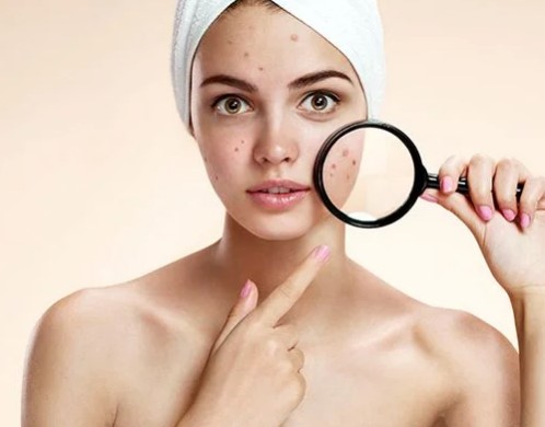 Akne ve Leke Bakımı Aures