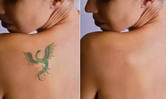 Dövme Silme Öncesi ve Sonrası