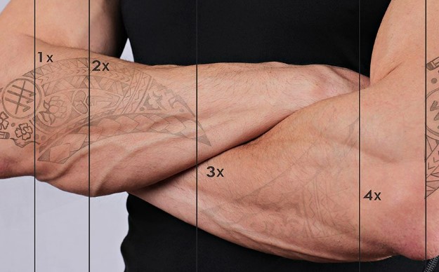 Lazerle Dövme Silme Uygulaması