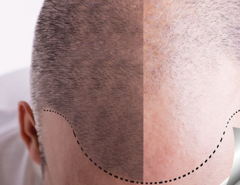 Saç Gürleştirme Sonuçları