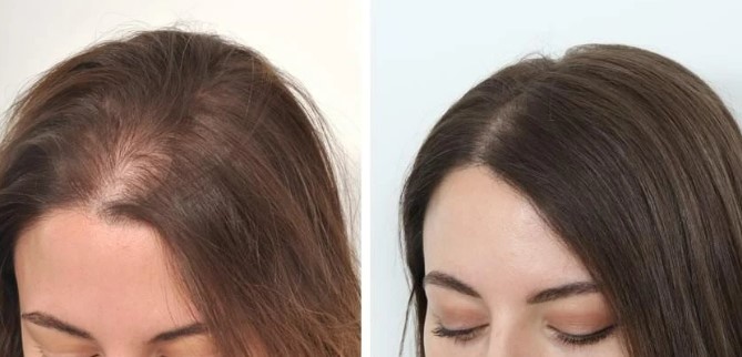 Saç Vitamini Mezoterapi İşlemi