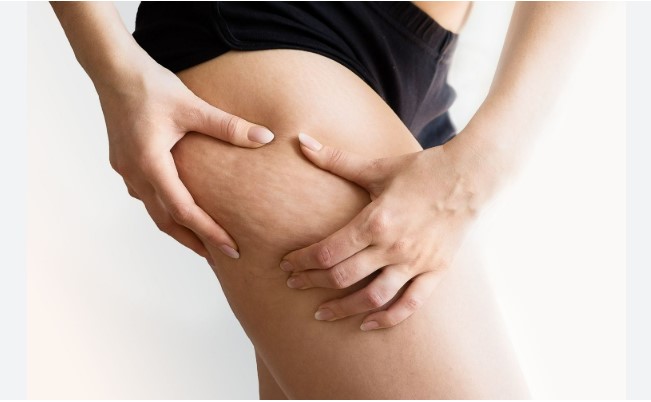 Selülit ve Çatlak Bakımı Uygulaması