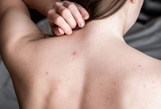 Sırt Aknesi ve Leke Bakımı